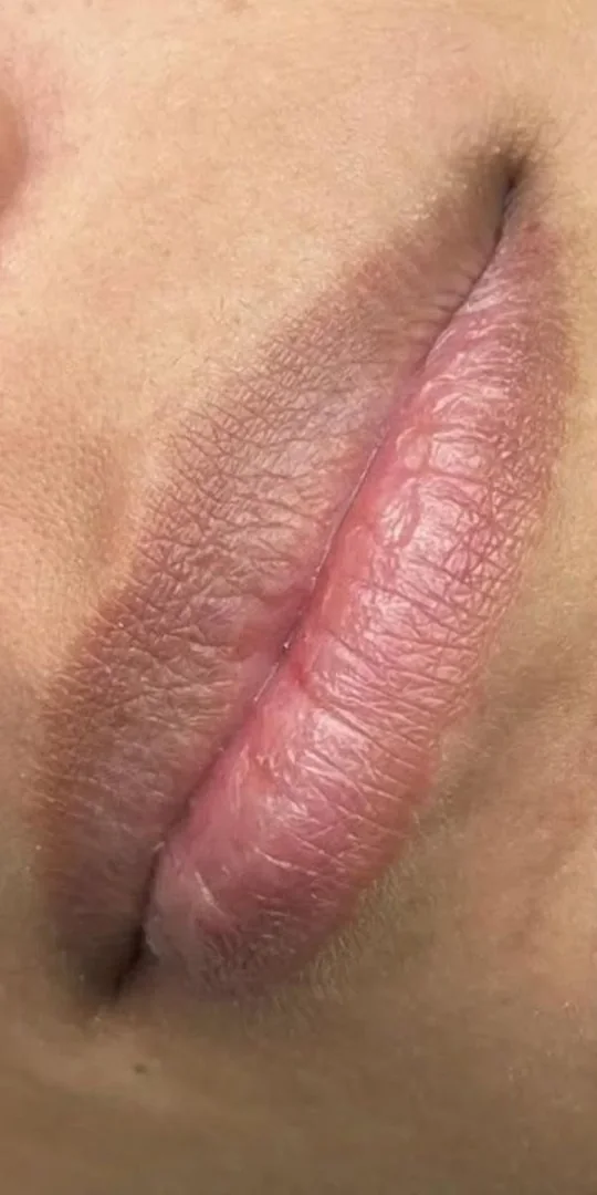 Lábios antes do microagulhamento labial, ressecados e com linhas verticais